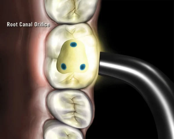 ORIKAM NEODETECT, CARIES AND CANAL DETECTOR